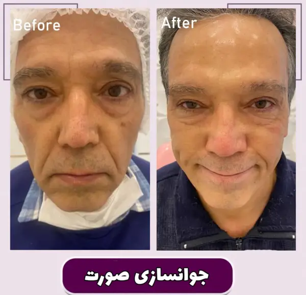 عکس مزو ژل زیر چشم