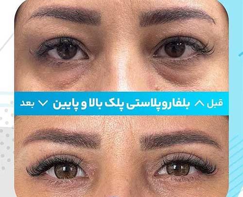 عکس رنگی چشم در شیراز