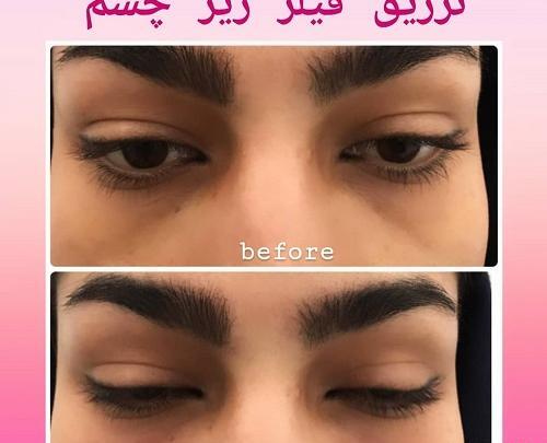 عکس فیلر چشم