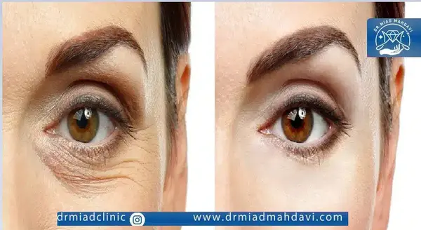 عکس فیلر چشم