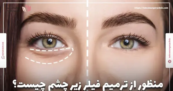عکس فیلر چشم