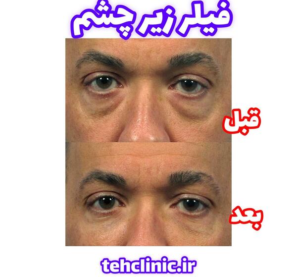 عکس فیلر چشم
