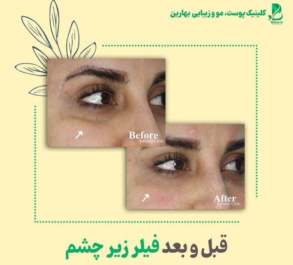 عکس فیلر چشم