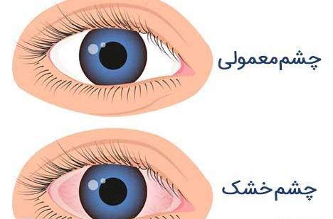 عکس چشم برای لیزیک