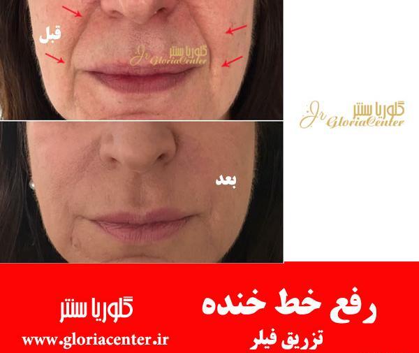 عکس خط خنده لب