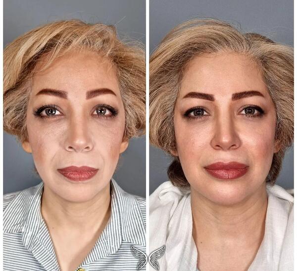 عکس خط خنده لب