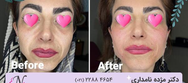 عکس خط خنده لب