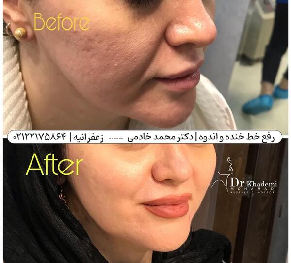 عکس خط خنده لب