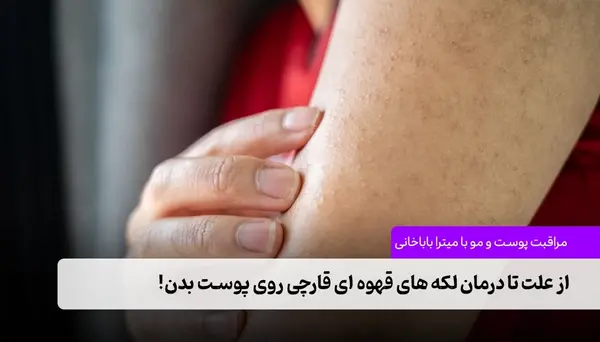 عکس لکه های قهوه ای قارچی روی پوست بدن