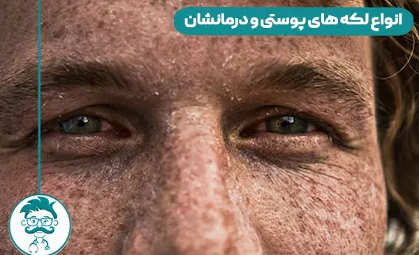 عکس لکه های قهوه ای قارچی روی پوست بدن
