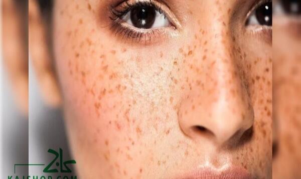 عکس لکه های قهوه ای قارچی روی پوست بدن