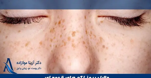 عکس لکه های قهوه ای قارچی روی پوست بدن