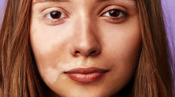 عکس لکه های قهوه ای قارچی روی پوست بدن