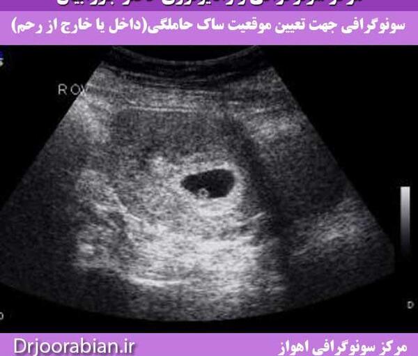 عکس سونوگرافی ماه اول بارداری