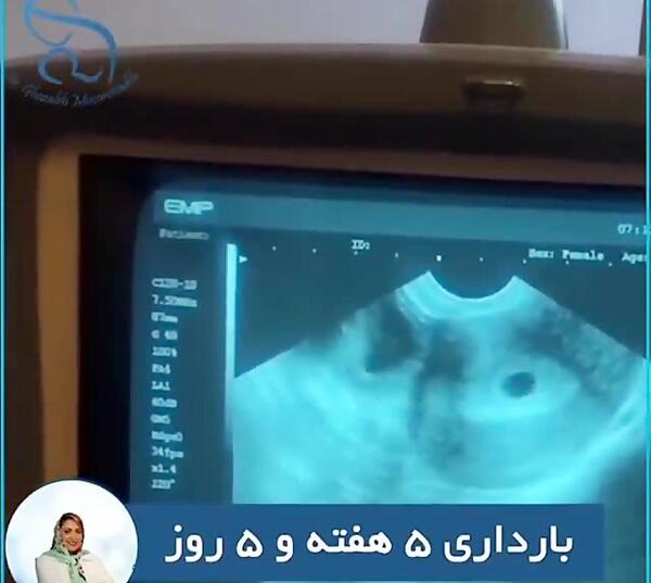 عکس سونوگرافی ماه اول بارداری