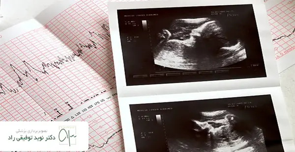 عکس سونو ماه اول بارداری