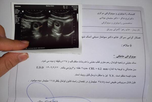 عکس سونو ماه اول بارداری