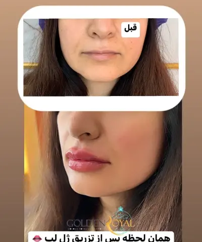 عکس ژل لب مردانه
