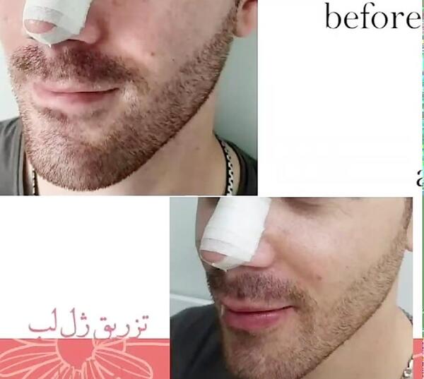 عکس ژل لب مردانه