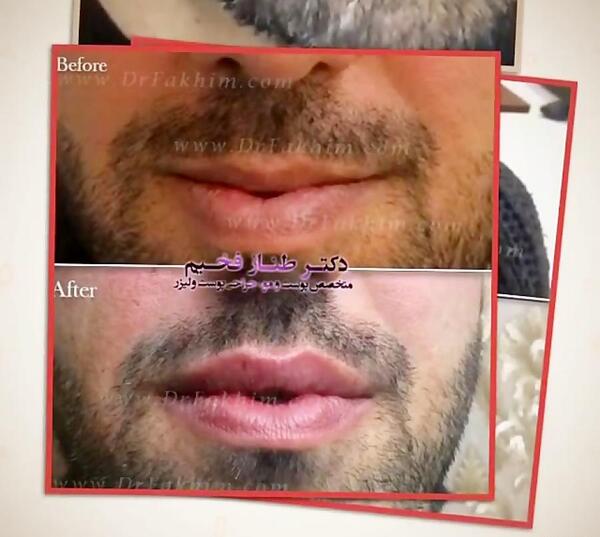 عکس ژل لب مردانه