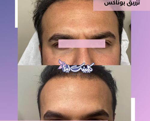 عکس ژل لب مردانه