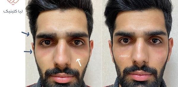 عکس ژل لب مردانه