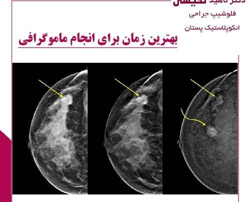 عکس ماموگرافی نرمال