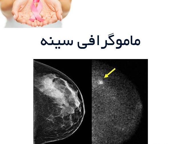 عکس ماموگرافی سرطانی