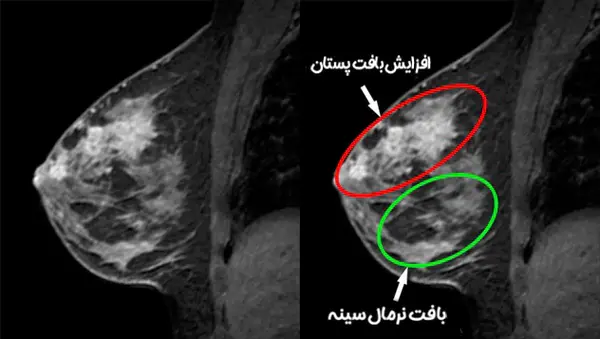 عکس ماموگرافی سرطانی