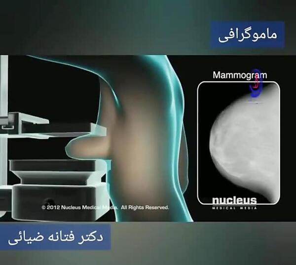 عکس ماموگرافی سرطانی