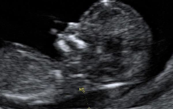 عکس جنین پسر و دختر در سونوگرافی