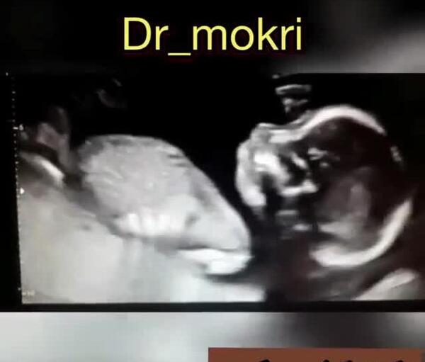 عکس جنین پسر 18 هفته ای