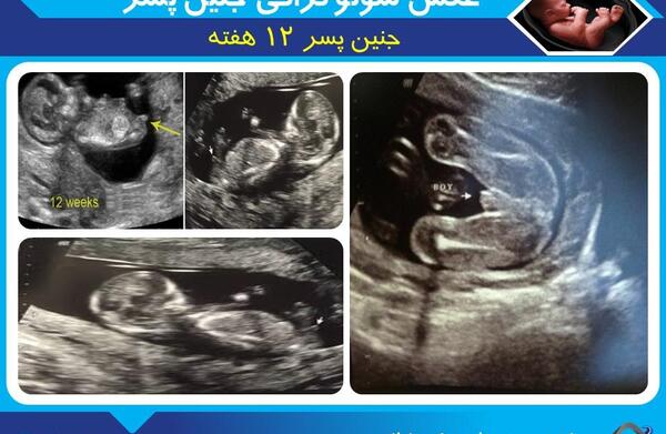 عکس جنین پسر 18 هفته ای