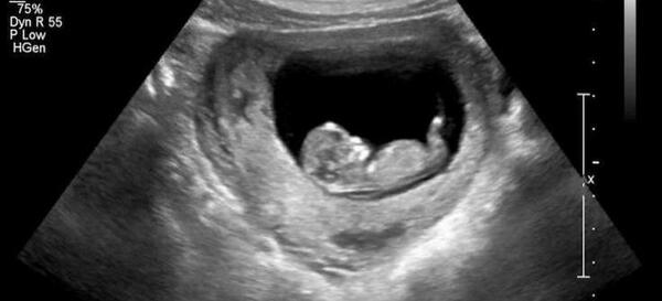 عکس جنین هجده هفته پسر