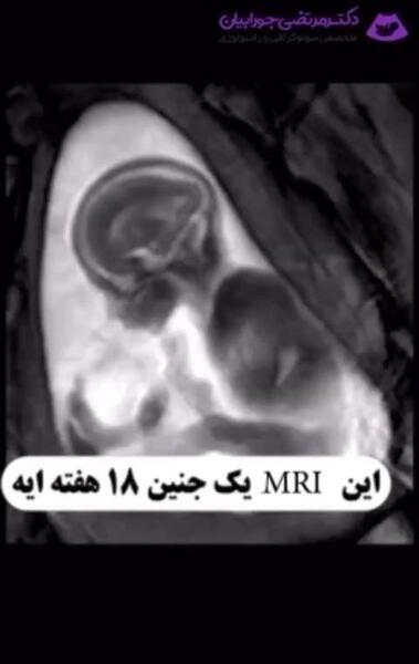 عکس جنین هجده هفته پسر