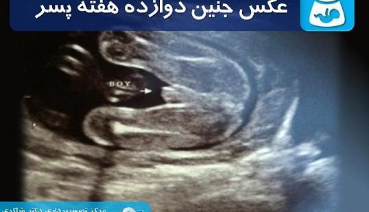 عکس جنین پسر 12 هفته