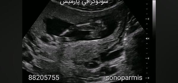 عکس جنین 18 هفته پسر