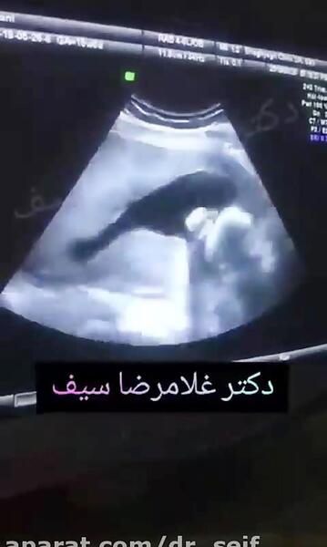 عکس جنین نوزده هفته پسر