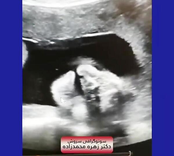 عکس جنین نوزده هفته پسر