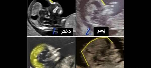 عکس جمجمه جنین پسر نی نی سایت