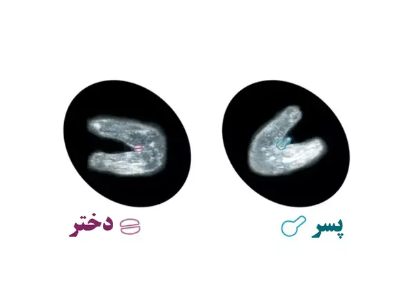 تفاوت عکس جنین دختر و پسر در سونوگرافی هفته 12