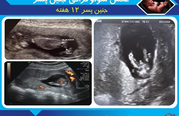 عکس جنین ۸ماهه پسر در شکم مادر