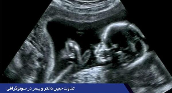 عکس جنین 11 هفته پسر