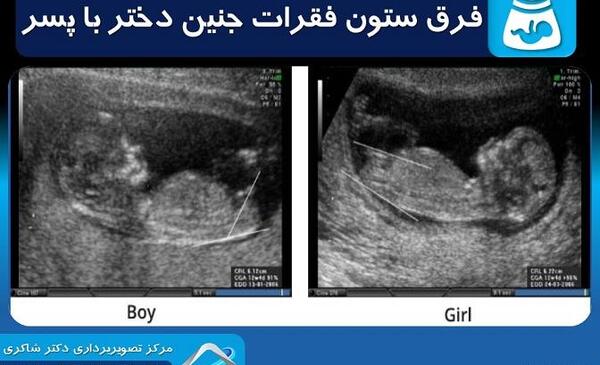 جنسیت عکس جنین 11 هفته پسر