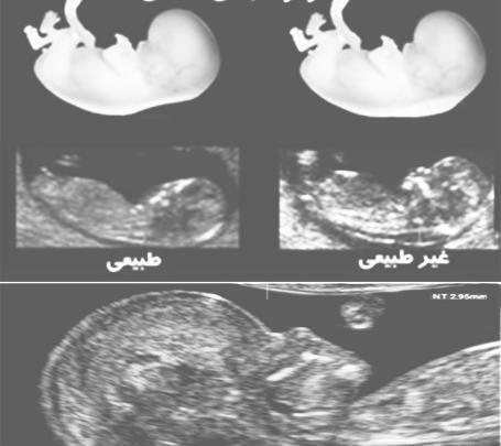 سونو nt عکس جنین 11 هفته پسر