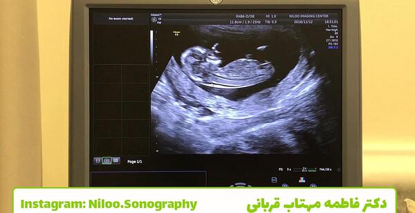 عکس جنین پسر در حالت بریچ