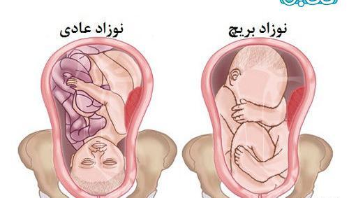عکس جنین پسر در حالت بریچ