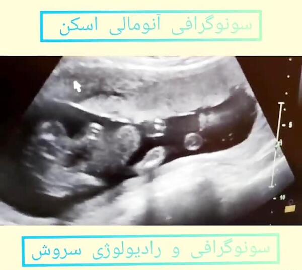 عکس جنین پسر در سونو آنومالی