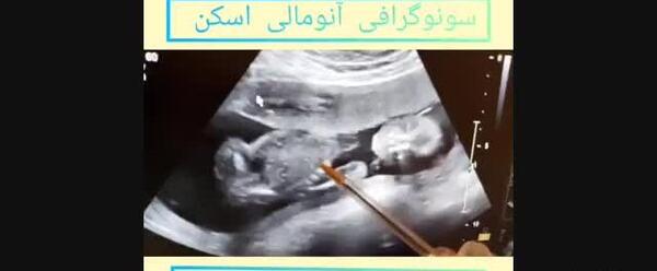 عکس جنین پسر در سونو آنومالی