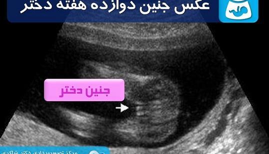عکس جنین دختر و پسر در ۱۲ هفتگی